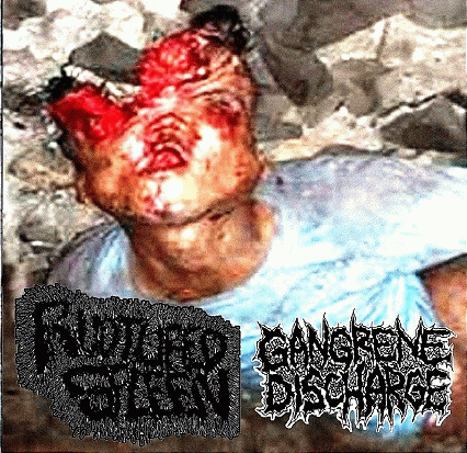 Gangrene Discharge : Ruptured Spleen - Gangrene Discharge